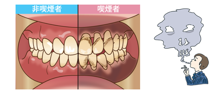 喫煙者の歯